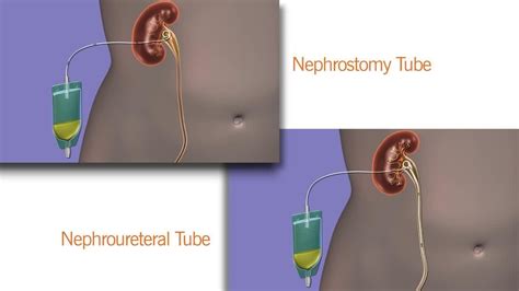 The nephroscope sheath is removed while visually inspecting the tract for bleeding. . What is a nephroureteral catheter